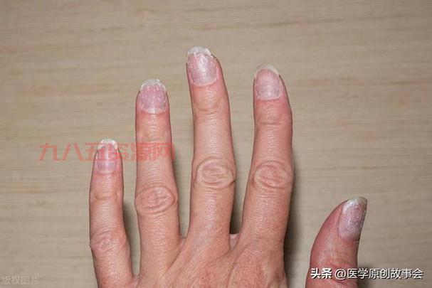 全球最长指甲的真实故事：李·雷德蒙德与吉尼斯世界纪录