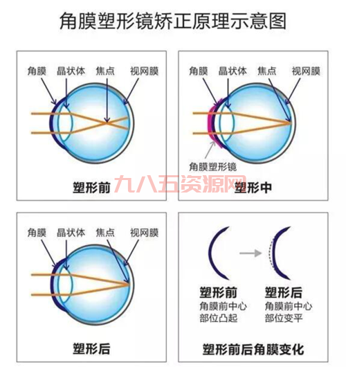 近视镜蚂蚁庄园：揭开近视眼镜的秘密