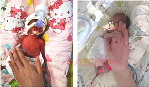 最小存活婴儿出院：370克超早产儿创造生命奇迹
